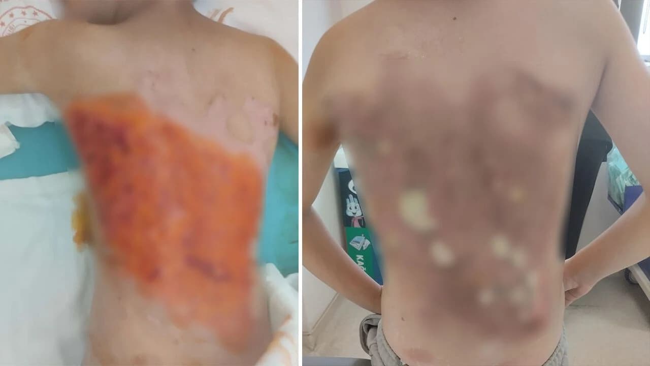 Arnavutköy’de akran zorbalığı iddiası: 12 yaşındaki çocuk kolonya dökülerek yakıldı