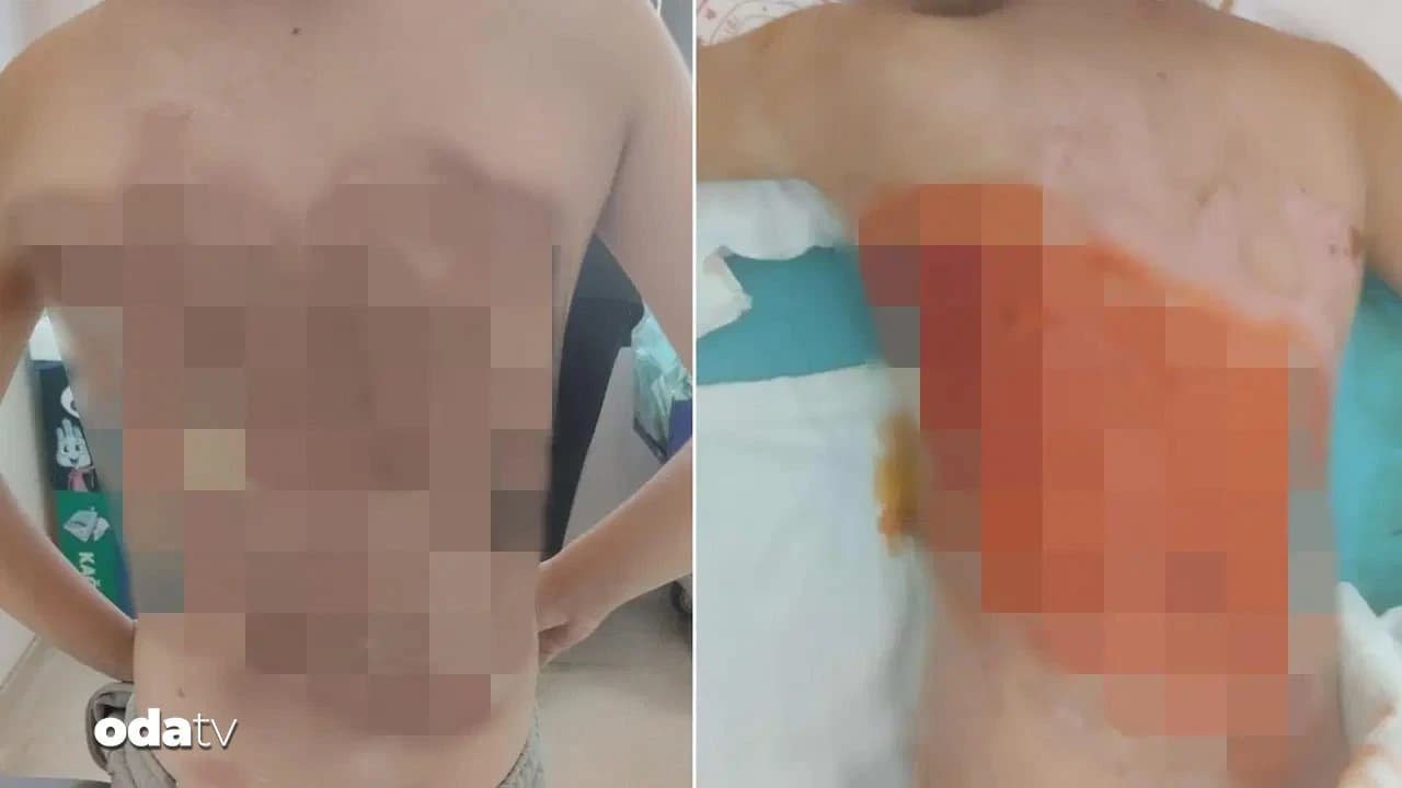 Akran zorbalığı: Kolonya ile yaktılar